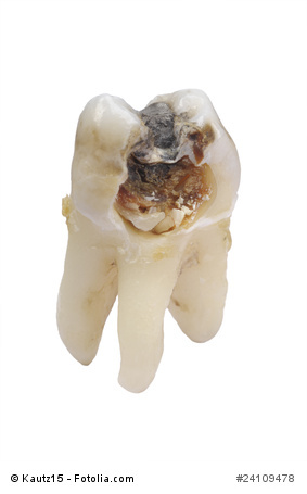 Loch Im Zahn Ursachen Und Behandlungsmoglichkeiten