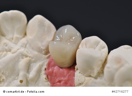 Teilkrone Ist Die Optimale Zahnbehandlung